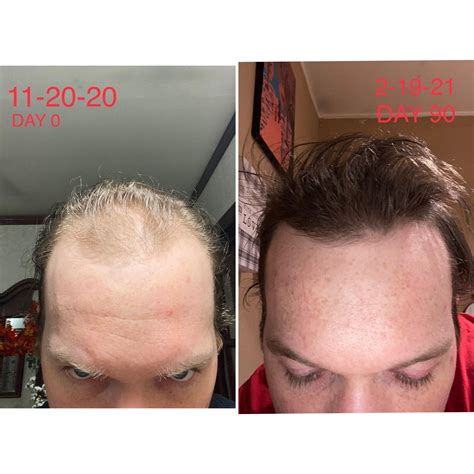 propecia results after 3 months.